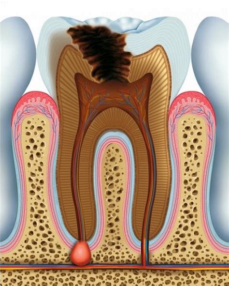 Clínica Dental Mercedes Reyes Qué es la endodoncia y en qué consiste