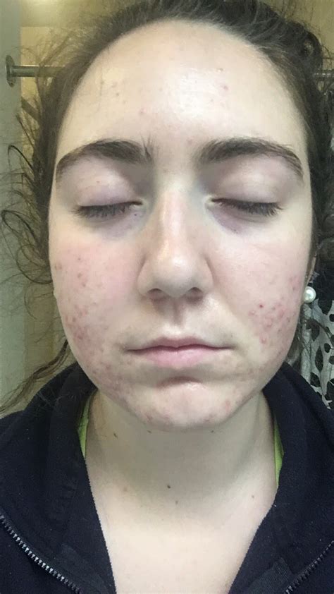Tretinoin Retin A Before And After Acne Katie Mcmanus
