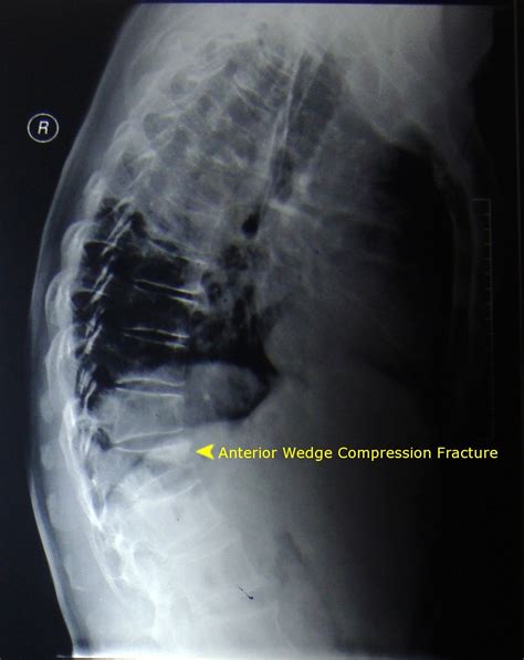 Anterior Wedge Compression Fracture Xray Pg Blazer