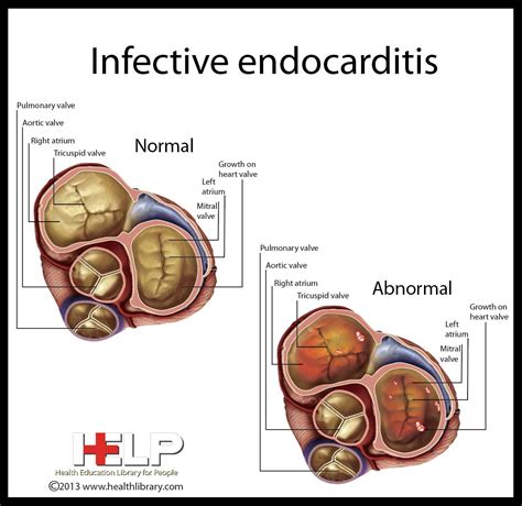 Infective Endocarditis Medical Surgical Nursing Pediatric Nursing