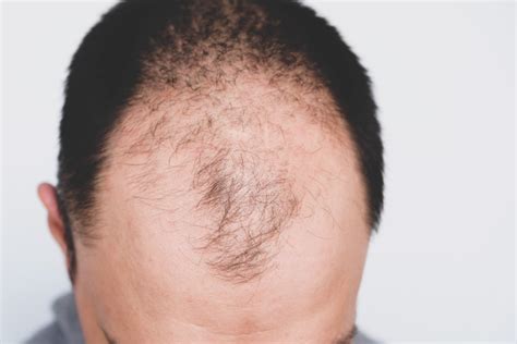 Male Pattern Baldness Embarrassing Problems