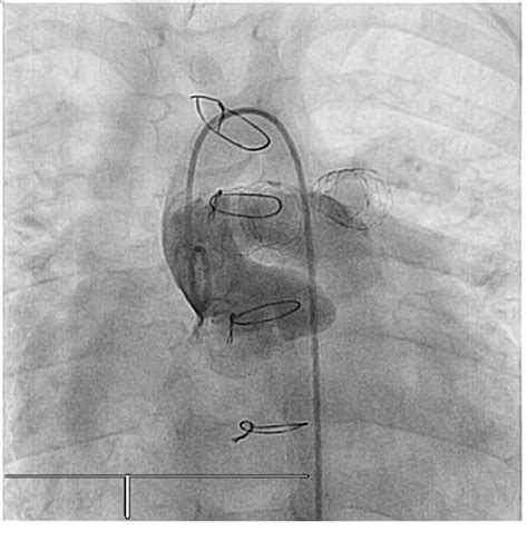 Figure 1 From Iatrogenic Aortopulmonary Fistula After Balloon Dilation