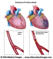 When a vasodilator is used, coronary arteries that are not narrowed coronary arteries cannot further dilate. Heart, Blood and Circulation Gallery - Medical Information ...