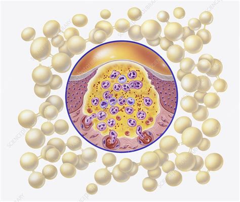 Staphylococcal Skin Infection Illustration Stock Image C0483106