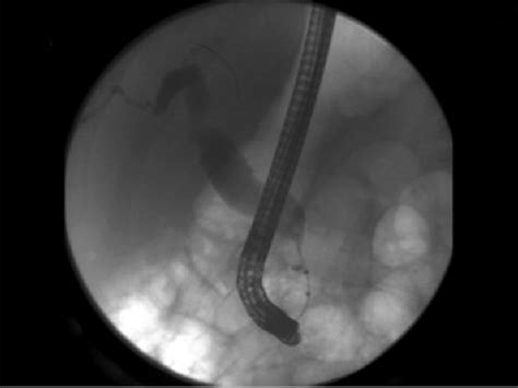 Ercp Smooth Concentric Narrowing Of The Distal Common