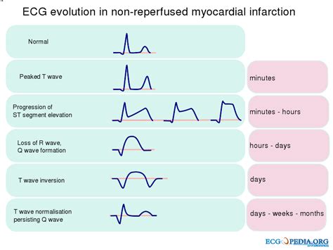 Medical Addicts Ecg Evolution Of Myocardial Infarction