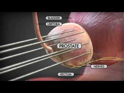 Cryotherapy For Prostate Cancer YouTube