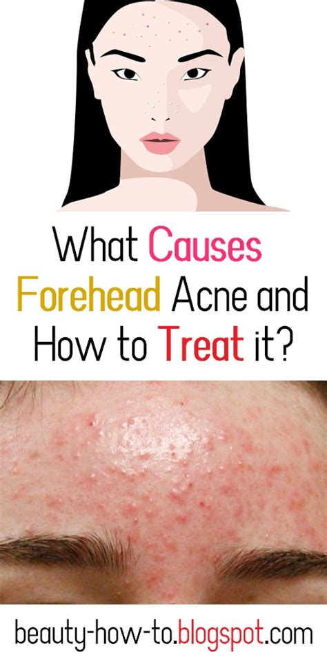 What Causes Forehead Acne And How To Treat It How To Beauty