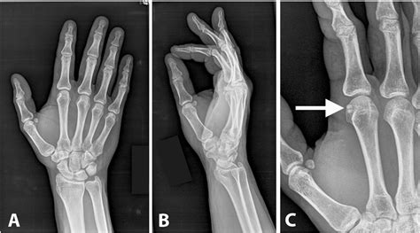 Fracture Of The Sesamoid Bone Of The Index Finger A Case Report