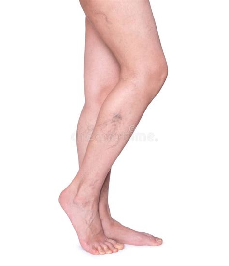 Varicose Veins In The Legs Woman Legs Isolated On White Stock Photo