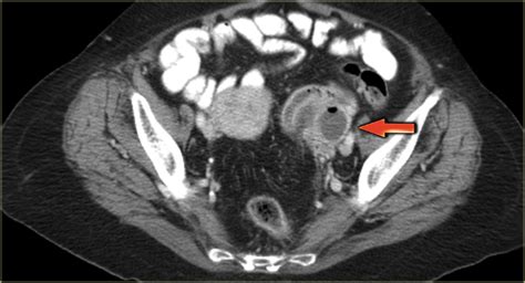 The Radiology Assistant Ovarian Cystic Lesions