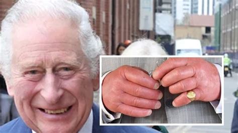 Prince Charles ‘sausage Fingers Spark Concern Doctor Explains Its