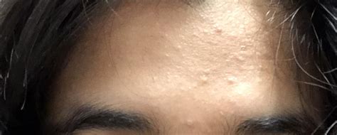 Skin Concern Weird Tiny Bumps On Forehead And Some On Cheeks How Do