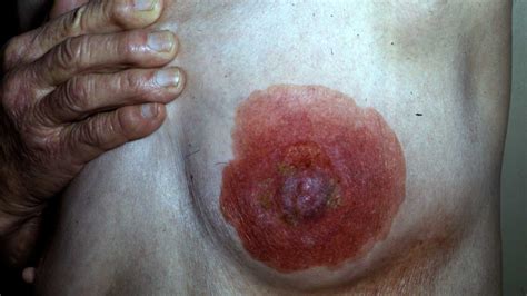Sir james paget first described paget disease (pd) of the breast in 1874. Paget's Disease of the Breast: Symptoms, Treatment, and More