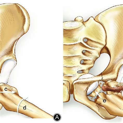 A Anterior Dislocation Of Hip Joint A Femoral Head Remains In The