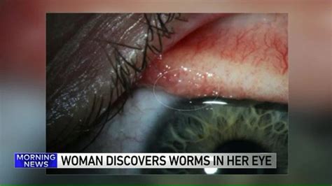 14 Worms Pulled From The Eye Of Woman With Rare Infection