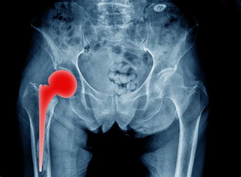 A hip resurfacing and hip replacement are both designed to improve your activity, function, and decrease your pain. Hip Replacement Surgery