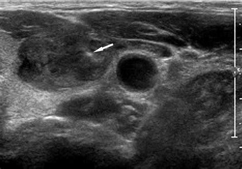 US Guided Fine Needle Aspiration Of Thyroid Nodules Indications