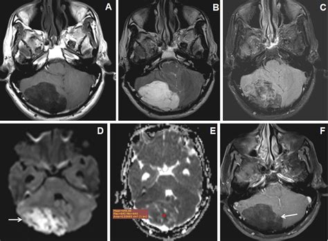 Posterior Cranial Fossa Tumor