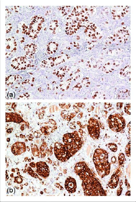 Immunohistochemical Expression Of Thyroid Transcription Factor1