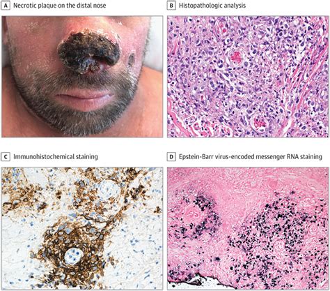 Necrotic Plaque On The Distal Nose With Diffuse Crateriform Nodules