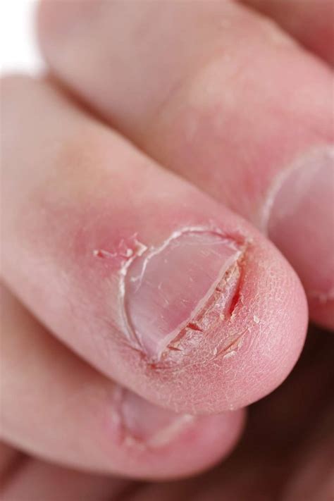 Leukonychia Vs Terry S Nails Bios Pics