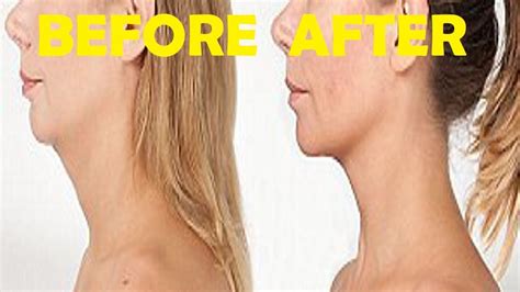 How To Get Rid Of Turkey Neck Without Surgery Turkey Neck Exercises