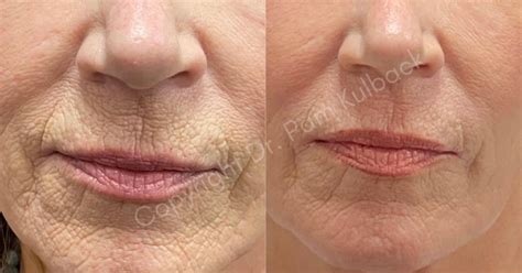 Tetra Co Laser Coolpeel The Latest In Laser Skin Resurfacing