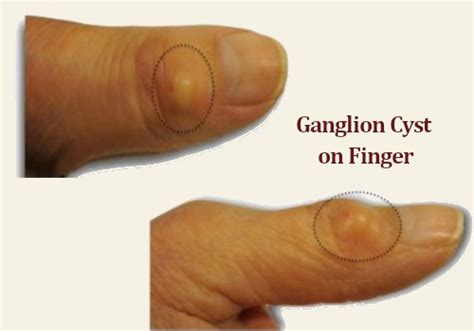 What Is A Ganglion Cyst Ganglion Cyst Removal Without Surgery