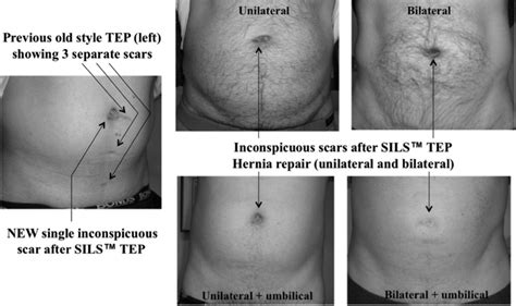 Laparoscopic Inguinal Hernia Repair Scars