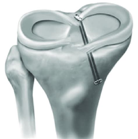 Transtibial Pull Out Repair Of A Medial Meniscal Posterior Root Tear In Download Scientific