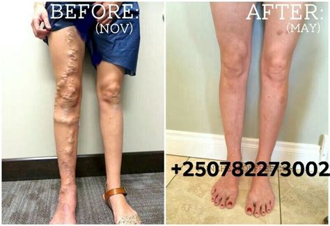 Pin On Varicose Veins Recovery