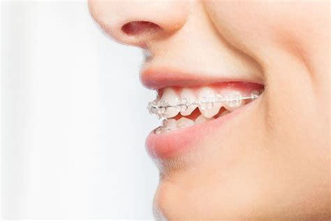 Difference Between An Overjet And Overbite A Comprehensive Guide Orthodontist Toronto