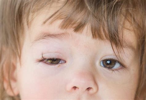 Most Effective Tips To Deal With 5 Most Common Eye Diseases In Kids