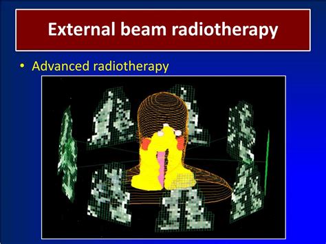 Ppt The External Beam Radiotherapy And Image Guided Radiotherapy 1