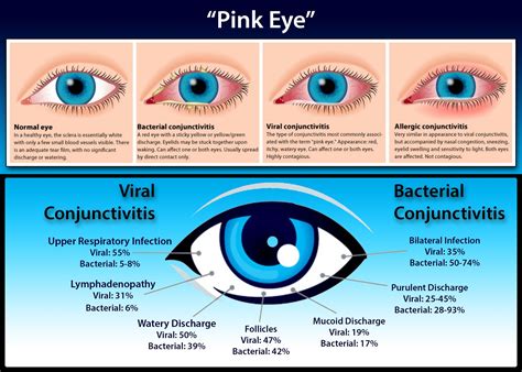 Conjunctivitis Or Pink Eye Is An Inflammation Of The Conjunctiva The