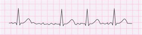 Badanie EKG w migotaniu przedsionków