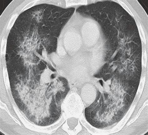The Ct Shows Bilateral Consolidation With Air Bronchograms With A