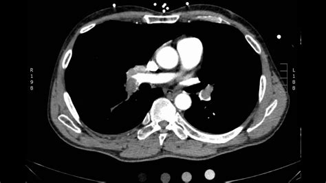Acute Massive Pulmonary Embolism With Right Heart Strain Ct Axial