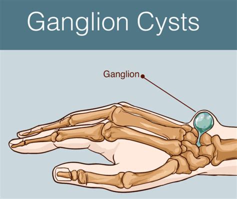 Ganglion Cyst Wrist Anatomy