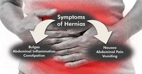 Hernias After Wls Causes Symptoms And Treatments Obesityhelp