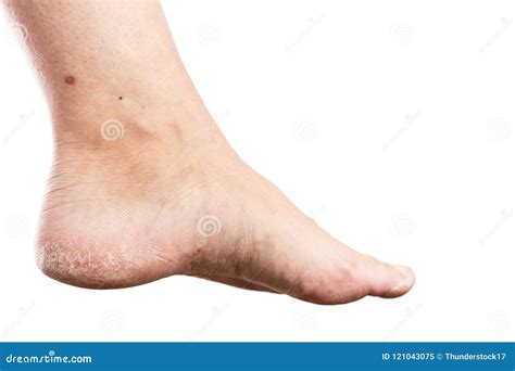Woman Foot With Cracked Heel Stock Image Image Of Condition Dermatology 121043075