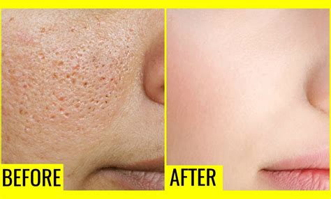 How To Shrink Large Pores Dermatologists Revealed 10 Ways Pure Life