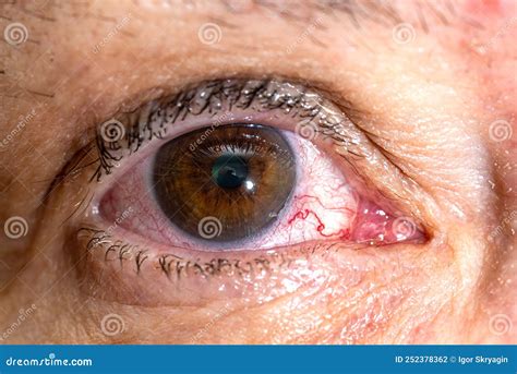 Close Up Of A Female Eye With Red Inflamed And Dilated Capillaries Blood Vessel Stock Photo