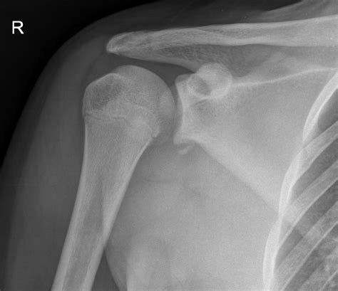 Hill-Sachs Deformity Archives | ALiEM