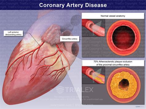 Coronary Artery Disease Of The Circumflex Artery Trial Exhibits