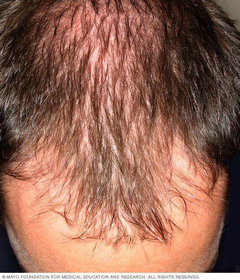 Hair Loss Disease Reference Guide