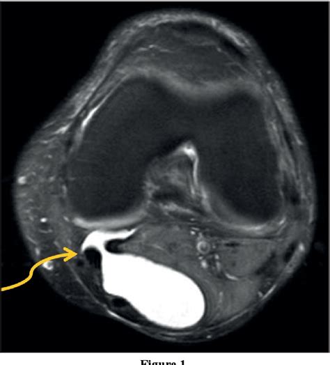 Figure 1 From Management Of Symptomatic Bakers Cysts With Ultrasound
