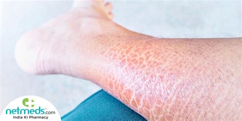 Ichthyosis Vulgaris Causes Symptoms And Treatment