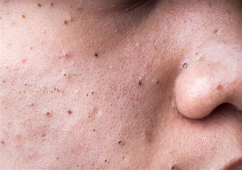 What Actually Are Blackheads Advanced Dermatology And Laser Institute Of Seattle